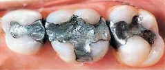Is there mercury in tooth fillings?