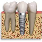 What are dental implants?