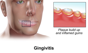 gingivitis